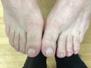 Nail Fungus after