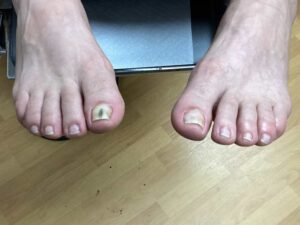 Nail Fungus before